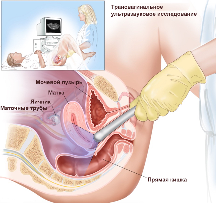 Подготовка к узи малого таза у женщин гинекология
