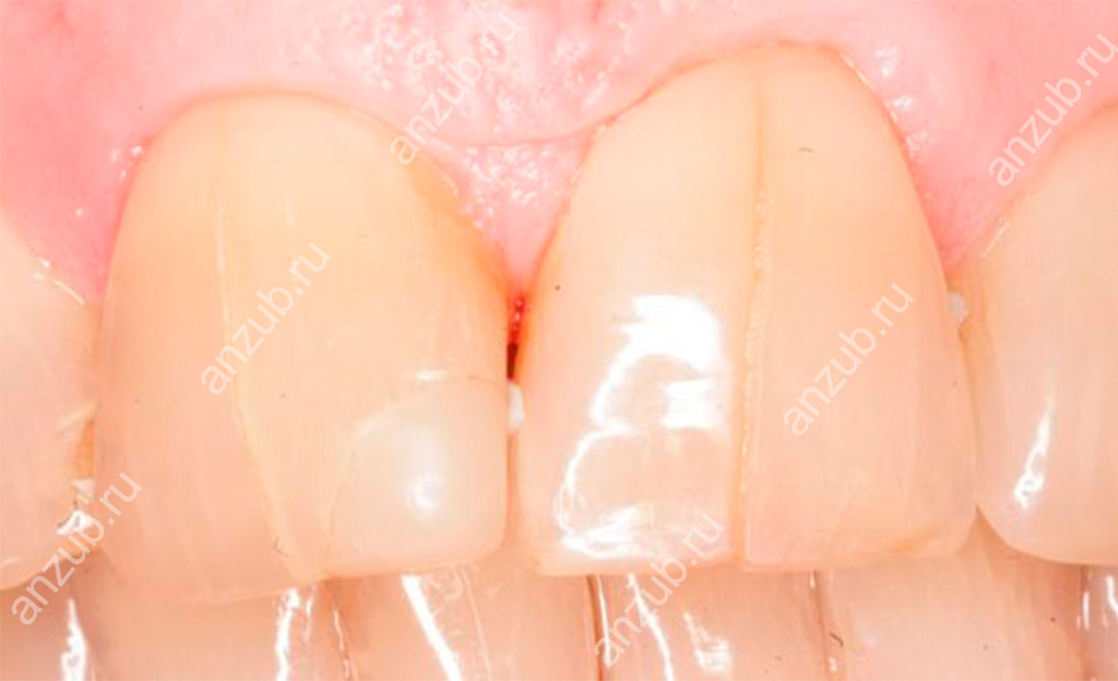 Почему возникает оскомина на зубах – основные причины и методы устранения